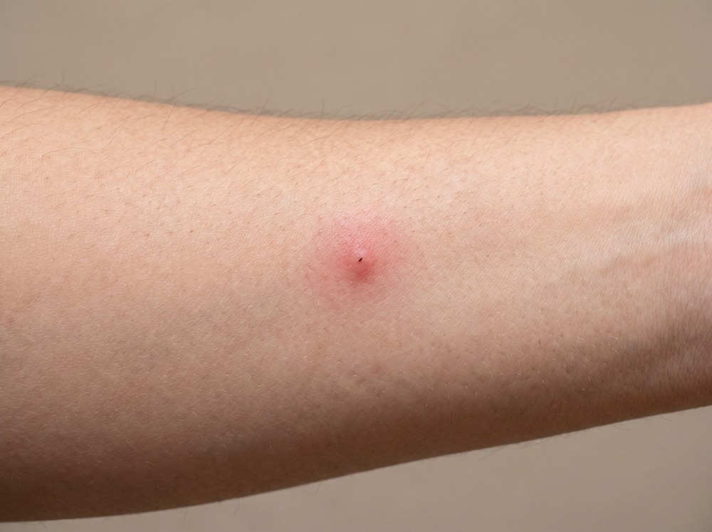 Close-up photograph of a small cluster of raised red itchy Asian tiger mosquito bite bumps on lower leg skin